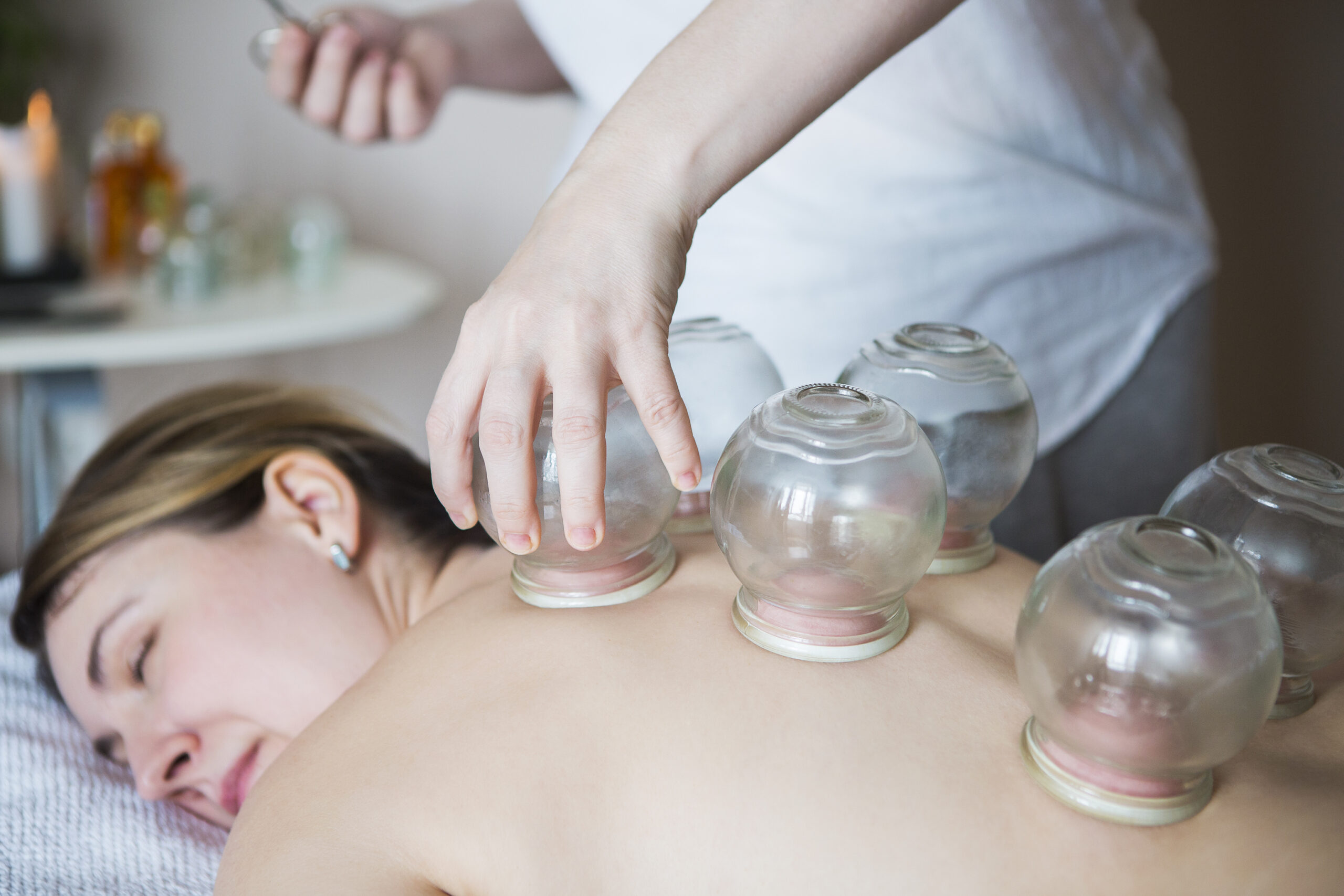 Cupping Therapy Edmonton session with therapist applying cups on patient back